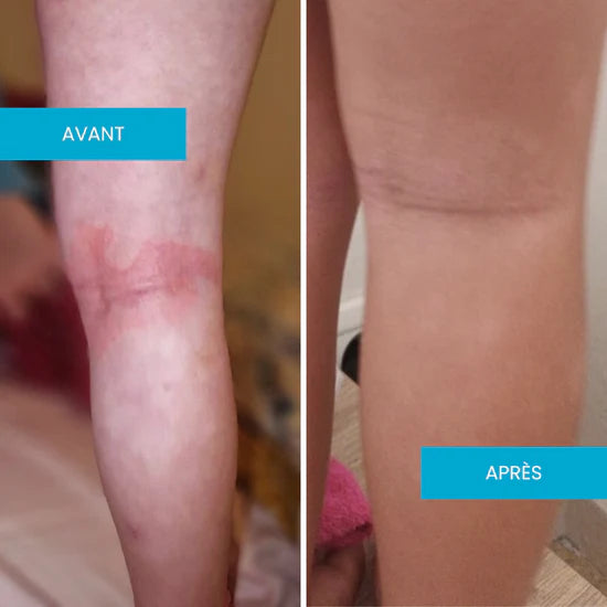 Crème Émolliente Eczéma Atopique