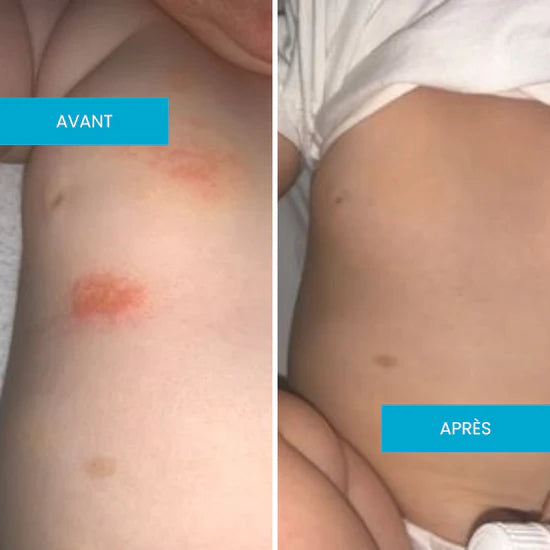 Crème Émolliente Eczéma Atopique