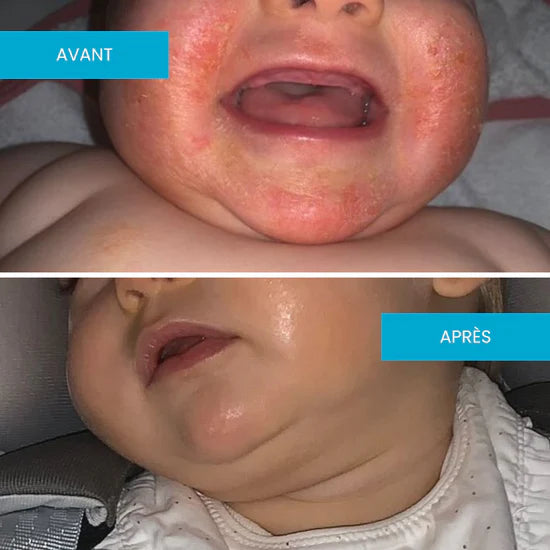 Crème Émolliente Eczéma Atopique